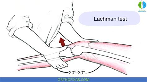 lachman compression test|lachman test results results.